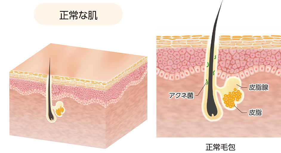 正常な肌・正常毛包