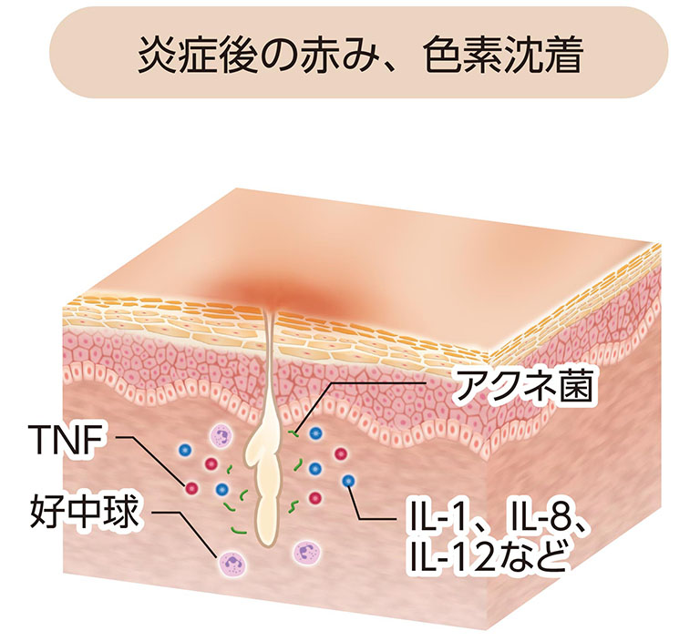 炎症後の赤み、色素沈着