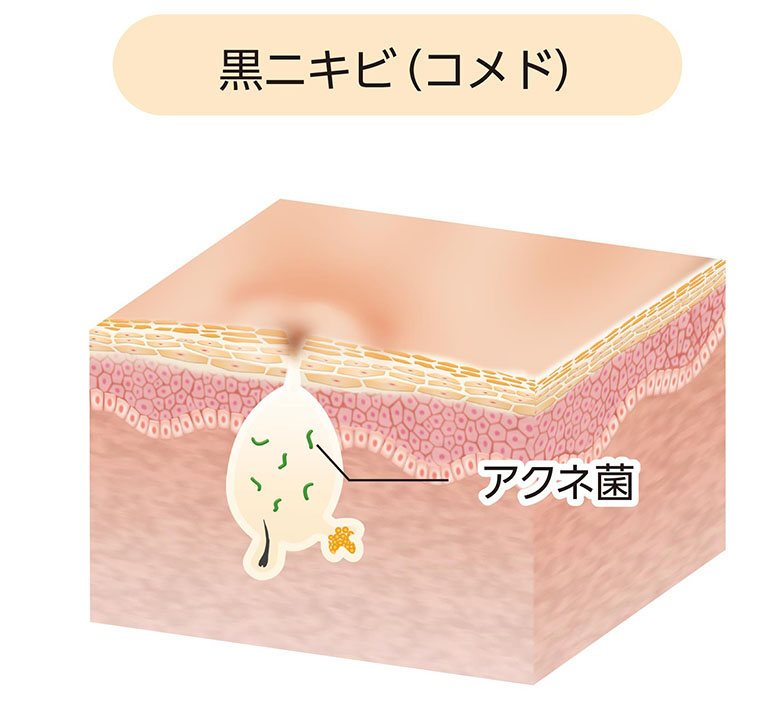 黒ニキビ（開放コメド）