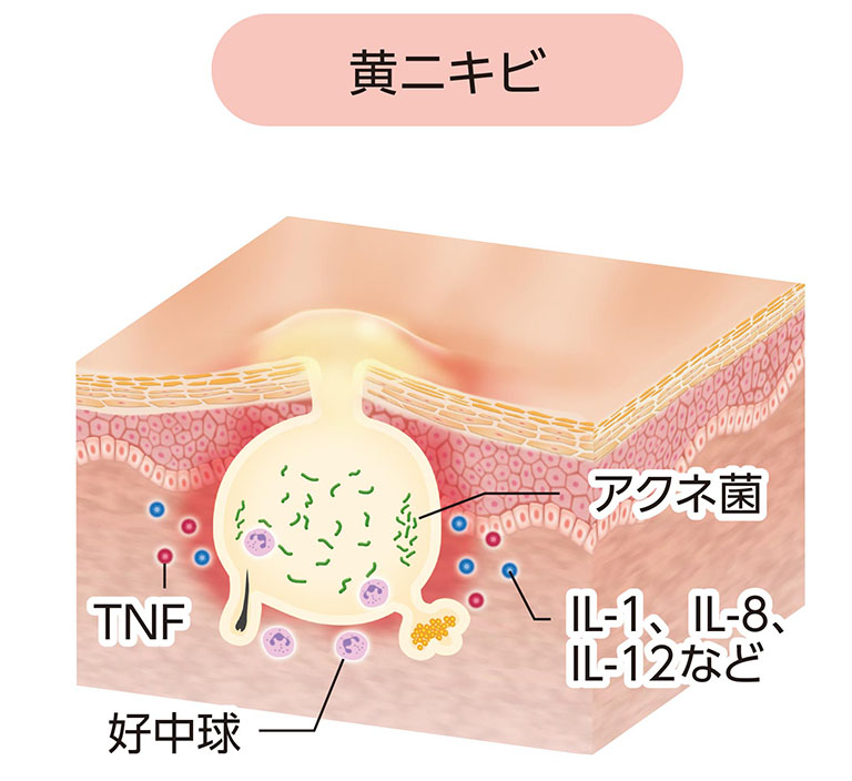 黄色ニキビ（膿疱）