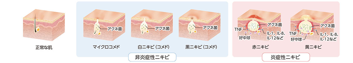 ざ瘡非炎症性ざ瘡と炎症性ざ瘡の比較