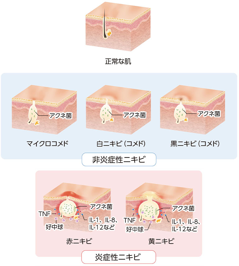 ざ瘡非炎症性ざ瘡と炎症性ざ瘡の比較