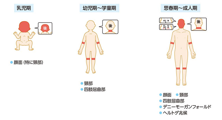 アトピー性皮膚炎の症状