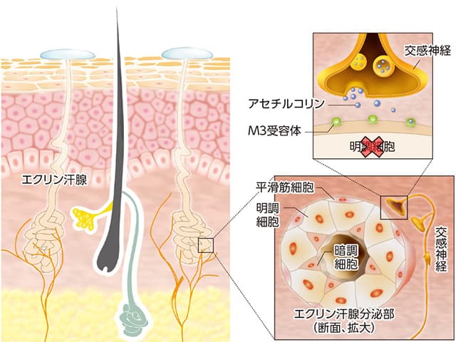 A型ボツリヌス毒素（BT-A）の局所注射