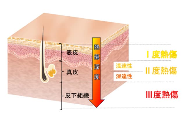 熱傷の程度
